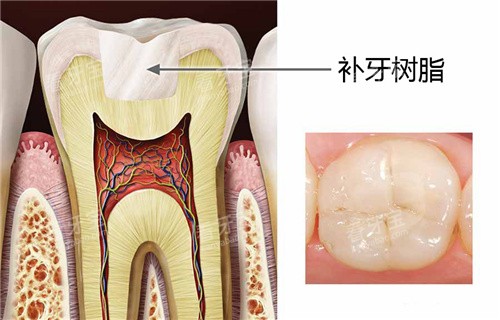 补牙树脂结果图 补牙树脂结果图