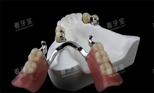 精密附着体义齿是什么 精密附着体义齿是什么