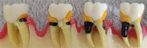 龋坏过程图 龋坏过程图