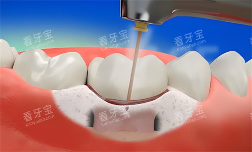 牙周炎激光治疗 牙周炎激光治疗