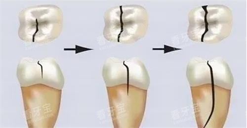 牙齿裂纹的发展过程 牙齿裂纹的发展过程