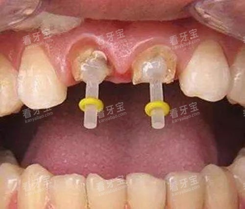牙齿打桩示意图 牙齿打桩示意图