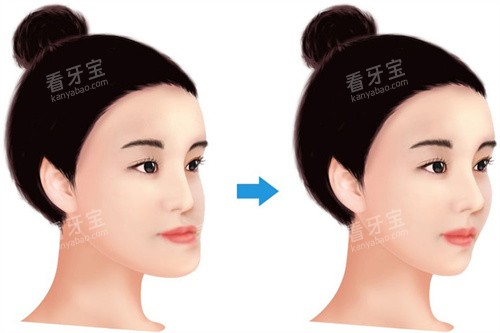 牙齿反颌面型差异 牙齿反颌面型差异