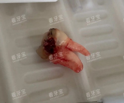 拔掉的牙 拔掉的牙