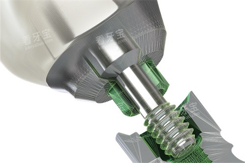 美国百好瑞种植牙植体连接处放大 美国百好瑞种植牙植体连接处放大