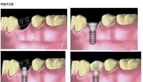 即刻种植步骤 即刻种植步骤