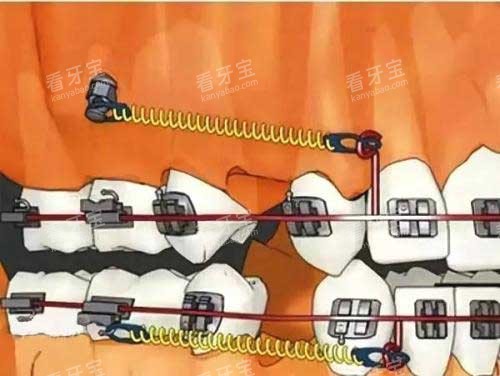 拔牙矫正骨钉种植钉 拔牙矫正骨钉种植钉