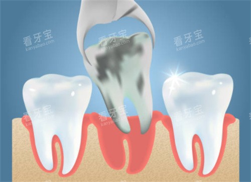 拔掉坏的牙齿 拔掉坏的牙齿