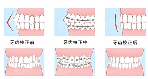牙齿矫正前后对比图 牙齿矫正前后对比图