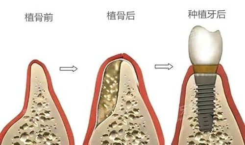 种植牙植骨前后于种植牙后漫画图 种植牙植骨前后于种植牙后漫画图