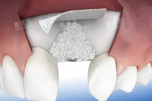 种植牙植骨卡通展示图 种植牙植骨卡通展示图