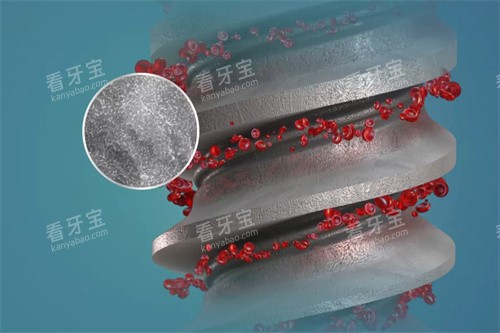 德国ABT种植牙表面结构 德国ABT种植牙表面结构