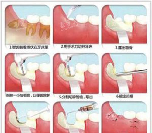 拔智齿过程示意图 拔智齿过程示意图