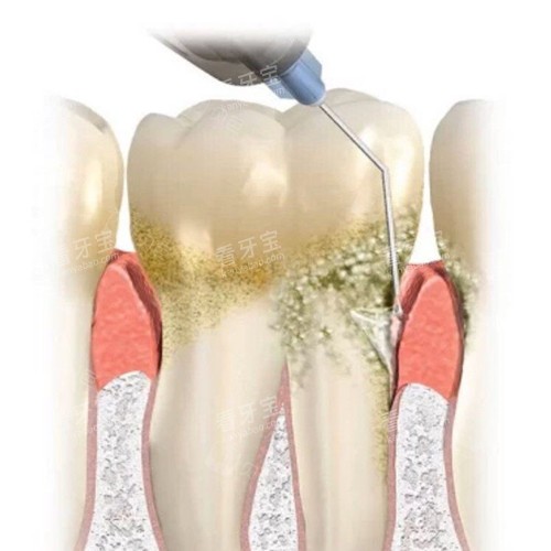 牙周刮治图片 牙周刮治图片