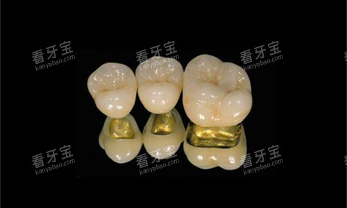 各类金属烤瓷牙展示图 各类金属烤瓷牙展示图