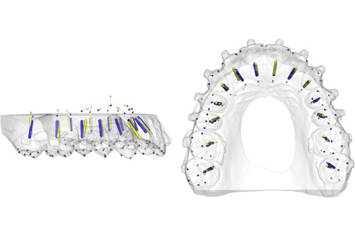 种植牙模拟图像 种植牙模拟图像