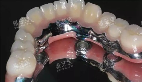 半口种植牙齿照片 半口种植牙齿照片