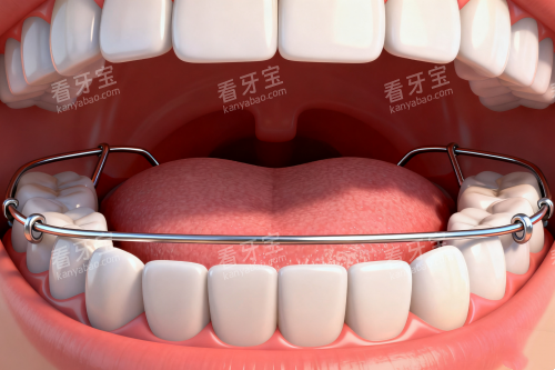 哈雷保持器在口腔中的样子一览 哈雷保持器在口腔中的样子一览