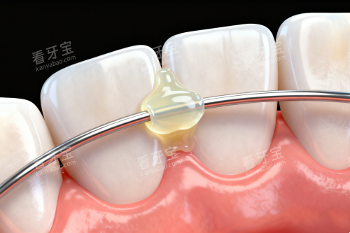 舌侧保持器展示图 舌侧保持器展示图