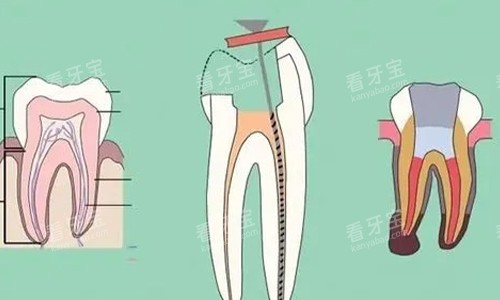 根管治疗的步骤示意 根管治疗的步骤示意