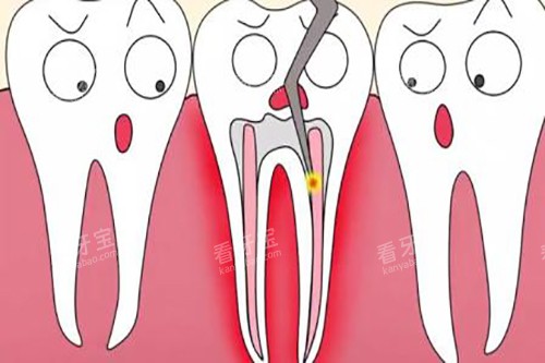 根管治疗卡通 根管治疗卡通
