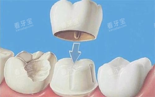 全瓷牙冠安装 全瓷牙冠安装