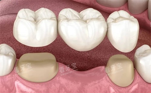 连冠全瓷牙 连冠全瓷牙