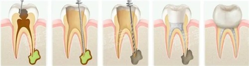 根管治疗步骤图 根管治疗步骤图