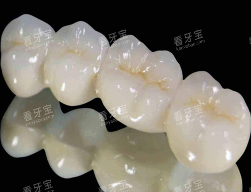 钯金烤瓷牙模型 钯金烤瓷牙模型