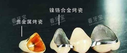 烤瓷牙不同材料示意图 烤瓷牙不同材料示意图