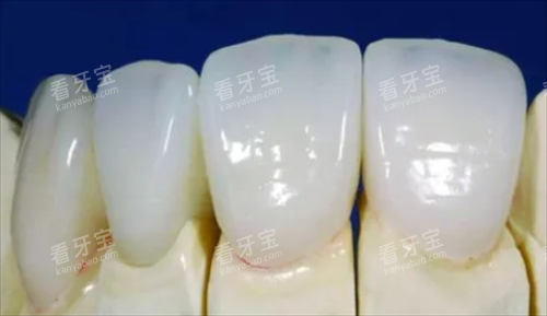 钯金烤瓷牙牙模型展示 钯金烤瓷牙牙模型展示