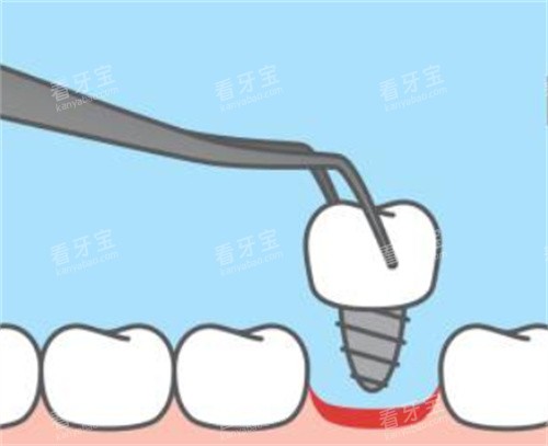 拔牙卡通图片 拔牙卡通图片