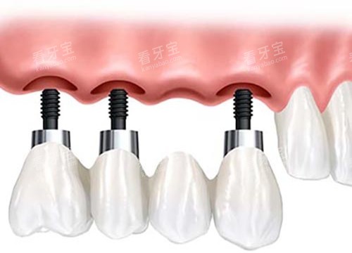 ��ֲ���̶����޸���