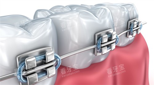 托槽矫正动画图 托槽矫正动画图