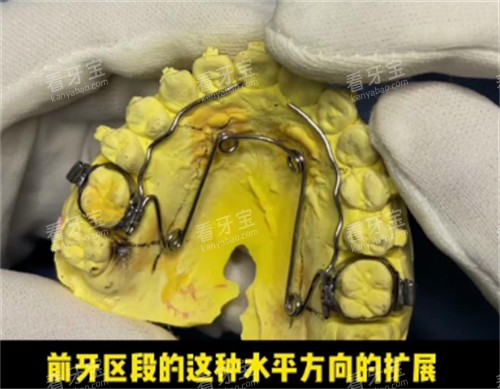 四眼簧扩弓器设计简介 四眼簧扩弓器设计简介