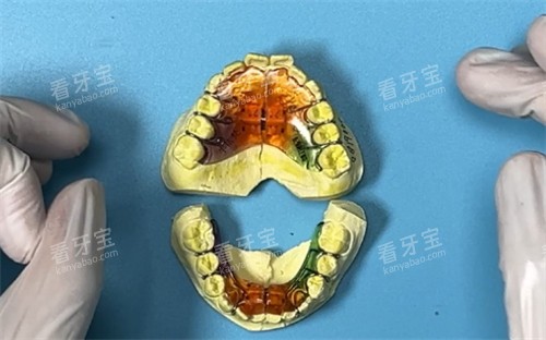 基托式螺旋扩弓器展示 基托式螺旋扩弓器展示