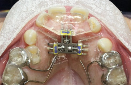 多方向扩弓器 多方向扩弓器