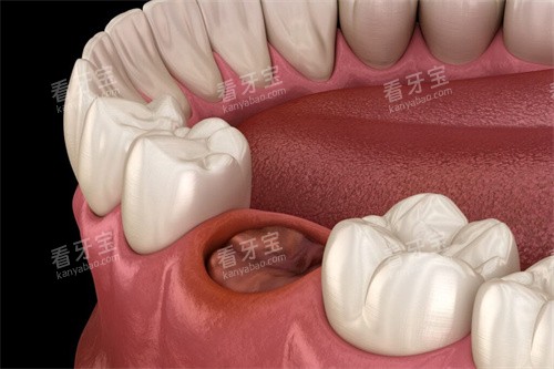拔牙后牙窝 拔牙后牙窝