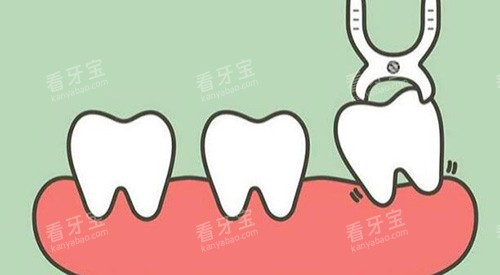 拔牙改善展示图照片 拔牙改善展示图照片