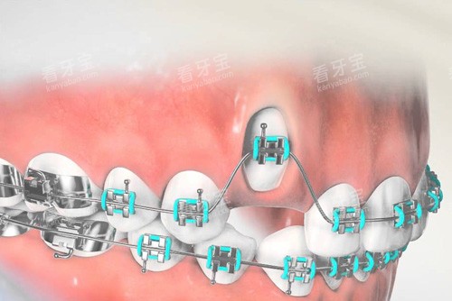 虎牙牙齿矫正过程 虎牙牙齿矫正过程