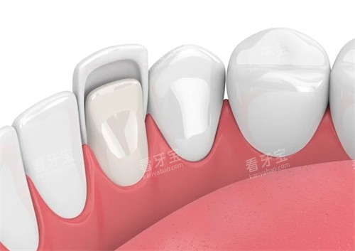牙齿贴面在口腔内的样子 牙齿贴面在口腔内的样子