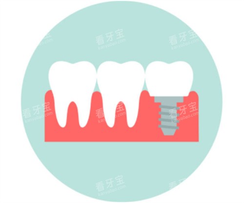 种植牙模拟卡通图 种植牙模拟卡通图