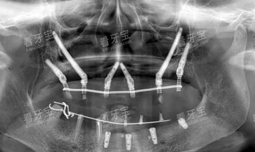 ��ȧ������ֲct��Ƭ