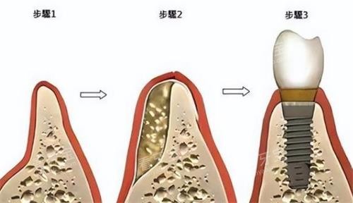 ���ƹǷ۵�ʹ�÷���