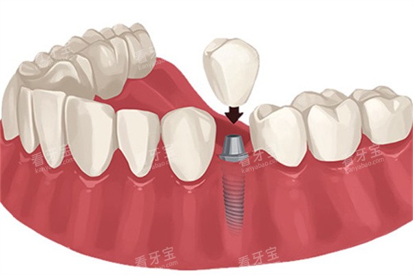 ��ֲ����װ����ʾ��ͼ