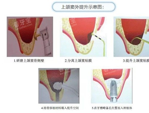 上颌窦提升过程 上颌窦提升过程