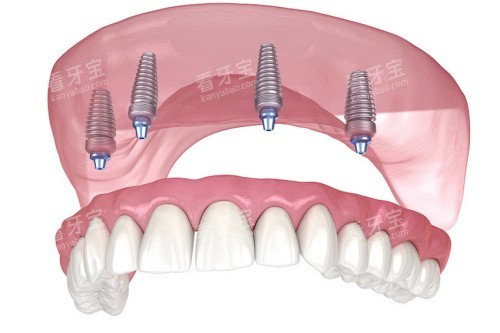 all-on-4��ֲ����ͼ