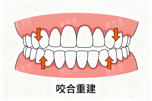 牙齿咬合重建卡通展示图 牙齿咬合重建卡通展示图