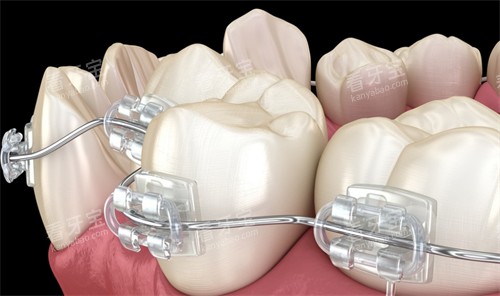 半隐形托槽牙齿矫正细节图 半隐形托槽牙齿矫正细节图