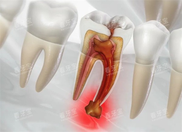 牙齿疼痛图片 牙齿疼痛图片